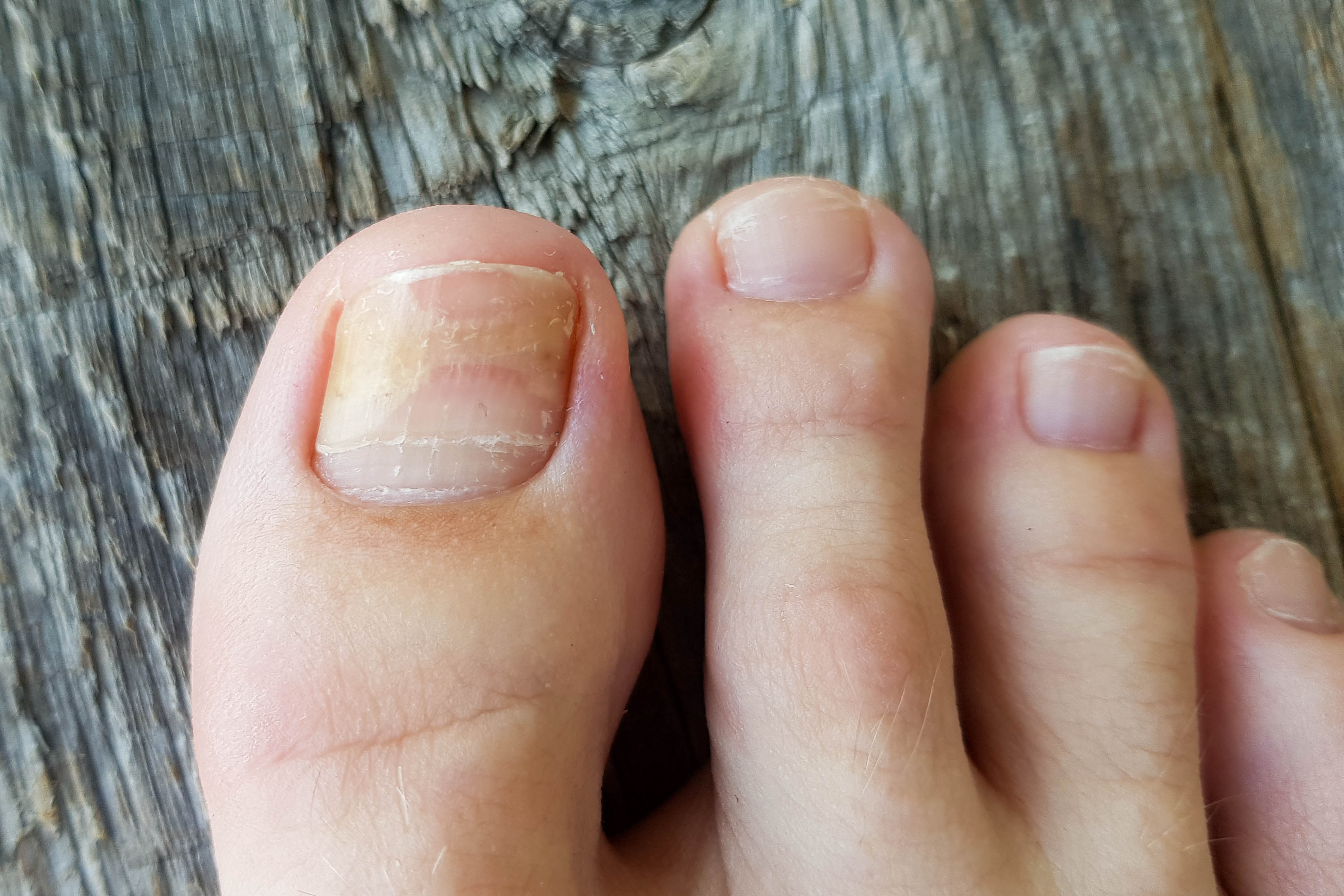 Avant / Après — pieds & ongles enfin sains